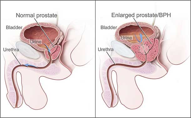 Benign Prostatic Hyperplasia